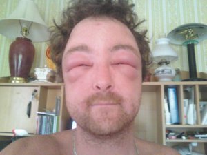 Photo d'une réaction allergique suite à une piqûre de frelon asiatique